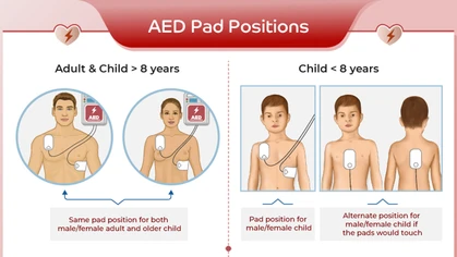 Timely use of an AED improves the chances of surviving sudden cardiac arrest by an astounding 600% over the odds of surviving without this intervention.