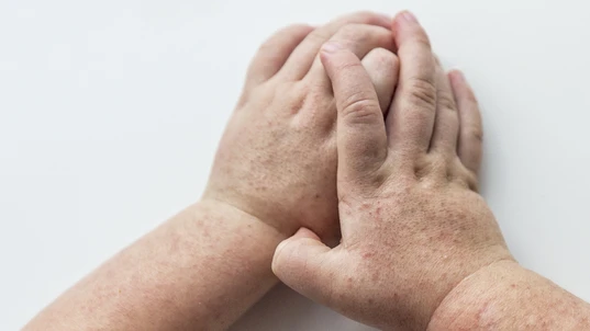 Scarlatina. Two children hands with contagious red small rash. White background.